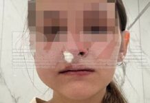 Как удаление зуба мудрости стало началом настоящего кошмара удаление зуба мудрости